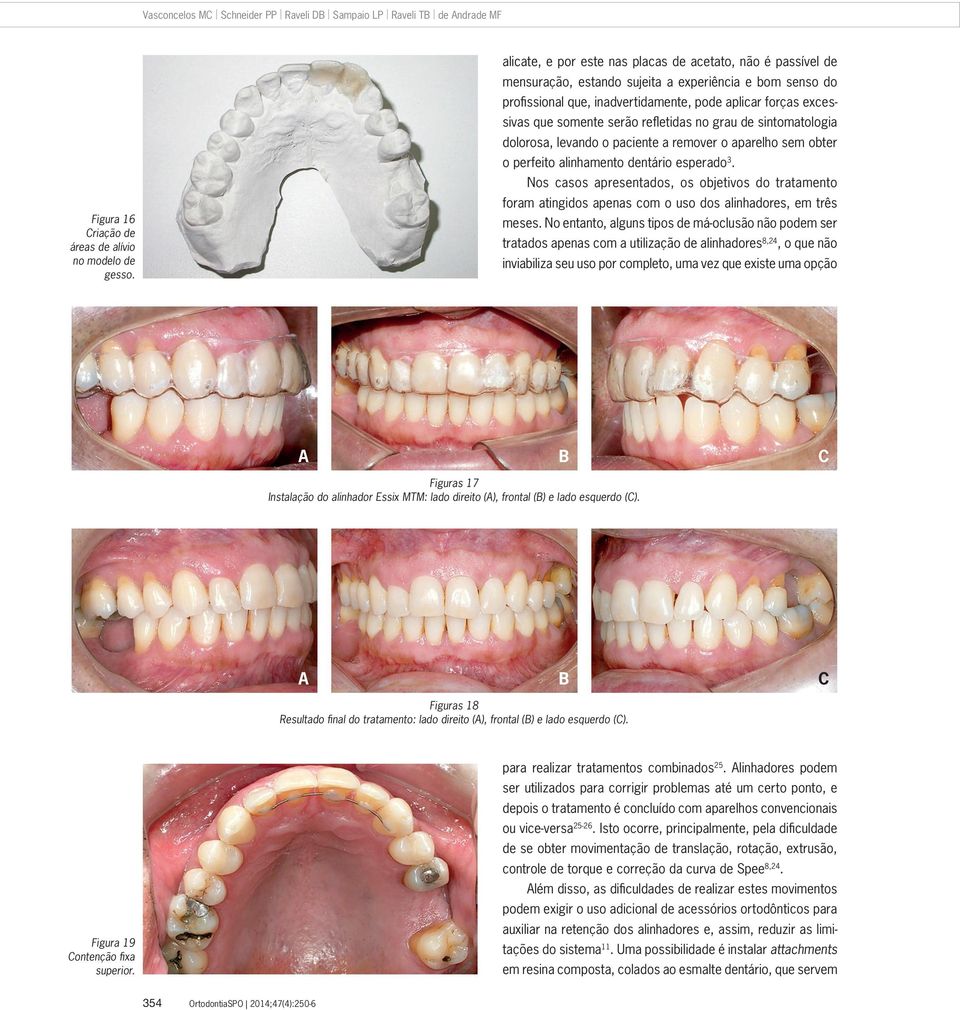 serão refletidas no grau de sintomatologia dolorosa, levando o paciente a remover o aparelho sem obter o perfeito alinhamento dentário esperado 3.