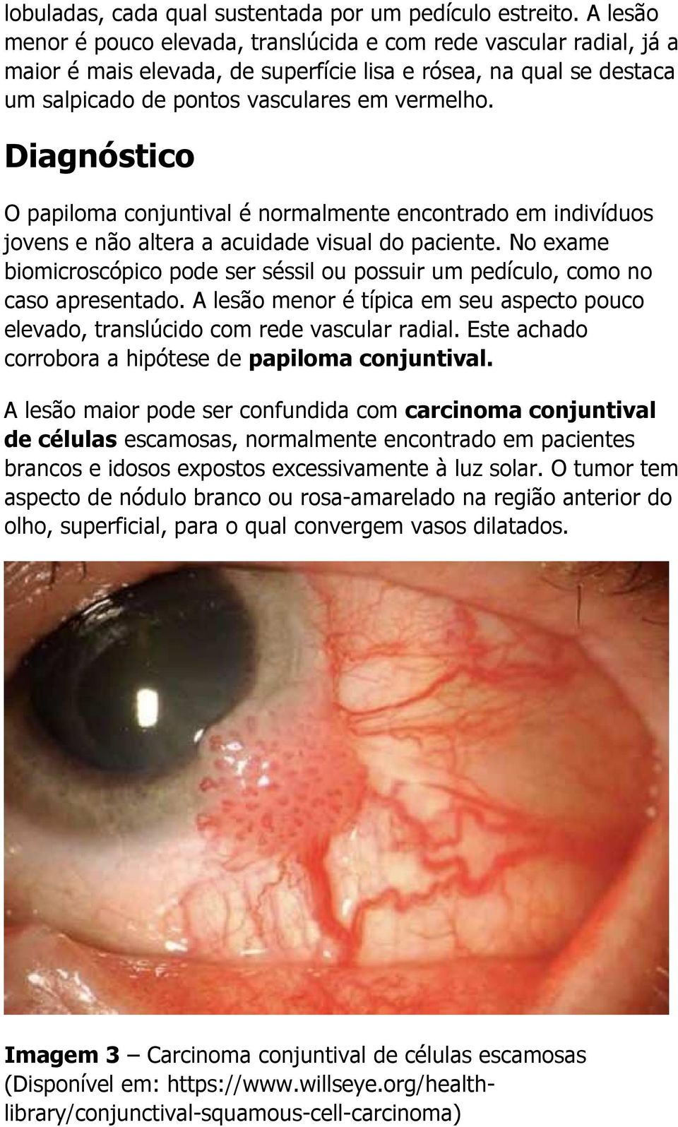 Diagnóstico O papiloma conjuntival é normalmente encontrado em indivíduos jovens e não altera a acuidade visual do paciente.