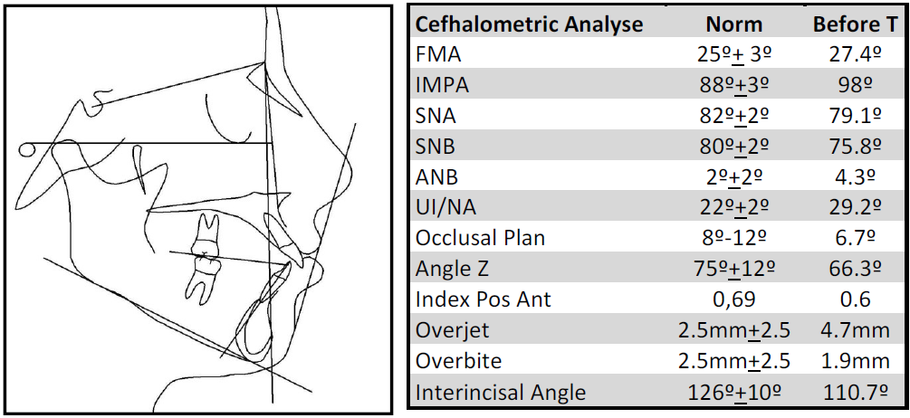 A avaliação cefalométrica (Figura 29) mostrou um padrão esquelético divergente, com uma relação de Classe I esquelética e alveolar.