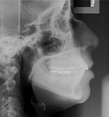 Figura 33: Radiografia panorâmica no pós-tratamento. Fonte: (Urzal e Ferreira, 2011). Figura 34: Radiografia cefalométrica no póstratamento.