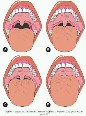 Índices de Mallampati Grau I: Visualização do palato mole, úvula e pilares Grau II: Visualização do palato mole