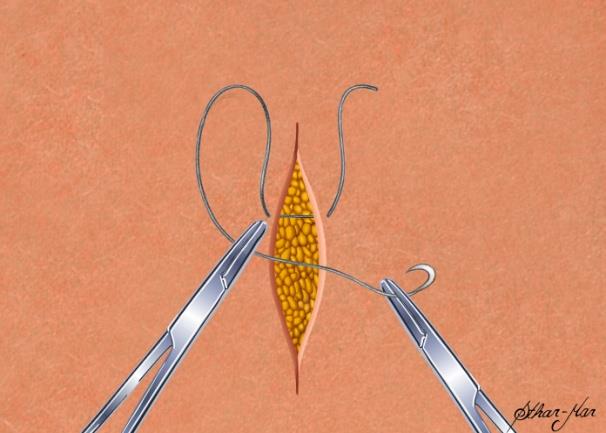 Treinamento em Sutura para a Cirurgia Bariátrica Laparoscópica O programa de treinamento de sutura do BariLap é voltado para desenvolver a técnica de sutura aplicada às dificuldades e posicionamento