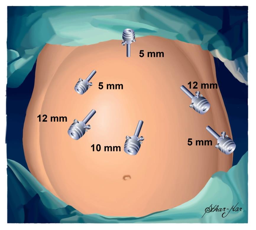 o Passagem dos trocateres Realiza-se a primeira incisão a aproximadamente 15 cm do apêndice xifóide, um pouco lateral à linha média, o que diminui o risco de hérnia incisional.