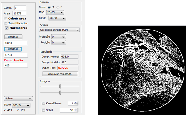 foram marcadas suas bordas e o sistema realizou cálculos de borda e o índice de tortuosidade. O programa possibilita uma análise mais detalhada dos dados da pessoa examinada.