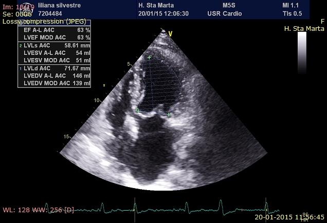 BIRD Ecocardiogramas - septo IA intacto - regurgitação mitral