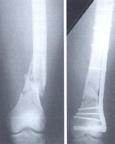 Fratura Distal do Fêmur: