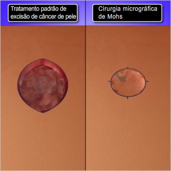 Introdução O câncer de pele está cada vez mais predominante, e estima-se que cerca de 20% da população mundial desenvolverá câncer de pele em sua vida.