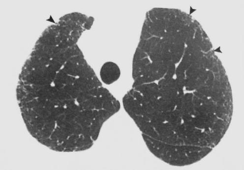 Padrão reticular Linhas intralobulares separadas por poucos milímetros resultando em um reticulado fino.