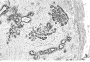 Invasão local Invasão tecidual Fibroadenoma de mama (cápsula fibrosa) Características anatomopatológicas: Metástase Trata-se de implante neoplásico descontínuo em relação à neoplasia primária.