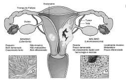 Metástase: disseminação hematógena Fígado com câncer metastático Tumor benigno X Tumor maligno Tumor benigno X Tumor maligno Characteristics Benign Malignant Differentiation/anaplasia Well