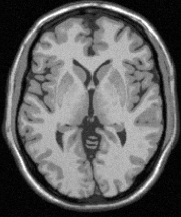 Experimentação Seção RM do Crânio Histograma GM WM T 1? T 2? T 3? T 4? CSF Fonte: Projeto Brainweb http://brainweb.bic.mni.mcgill.