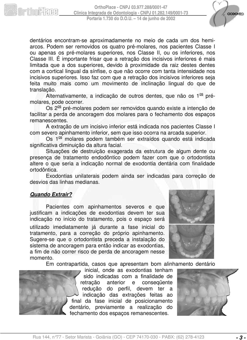 É importante frisar que a retração dos incisivos inferiores é mais limitada que a dos superiores, devido à proximidade da raiz destes dentes com a cortical lingual da sínfise, o que não ocorre com