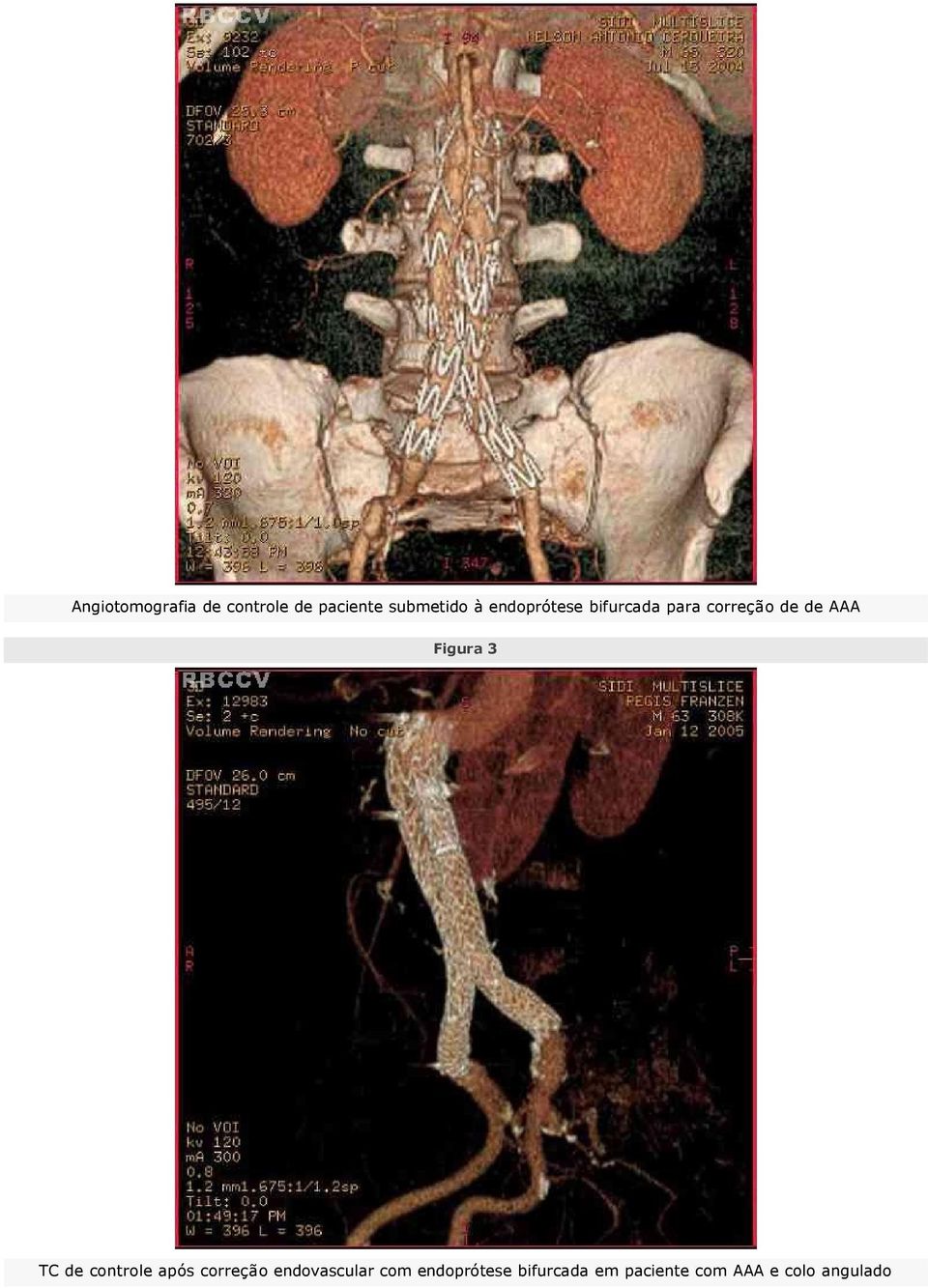 3 TC de controle após correção endovascular com