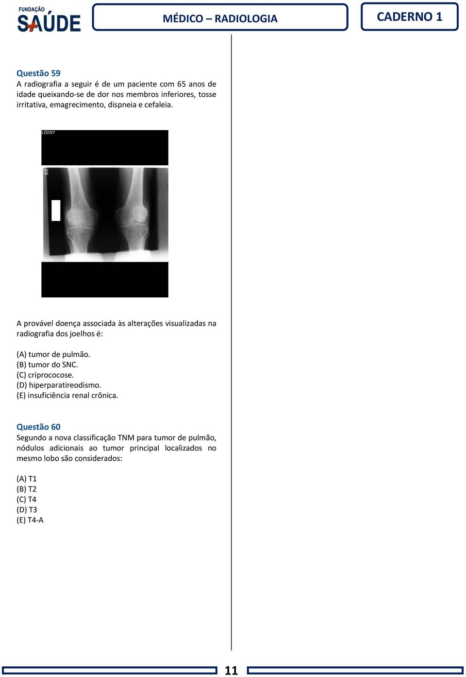 A provável doença associada às alterações visualizadas na radiografia dos joelhos é: (A) tumor de pulmão. (B) tumor do SNC.