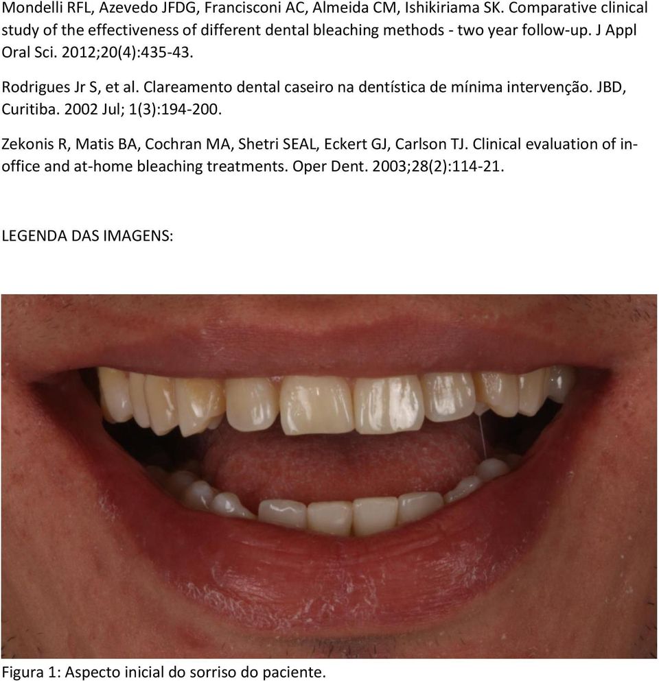 Rodrigues Jr S, et al. Clareamento dental caseiro na dentística de mínima intervenção. JBD, Curitiba. 2002 Jul; 1(3):194-200.