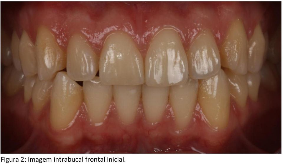 intrabucal