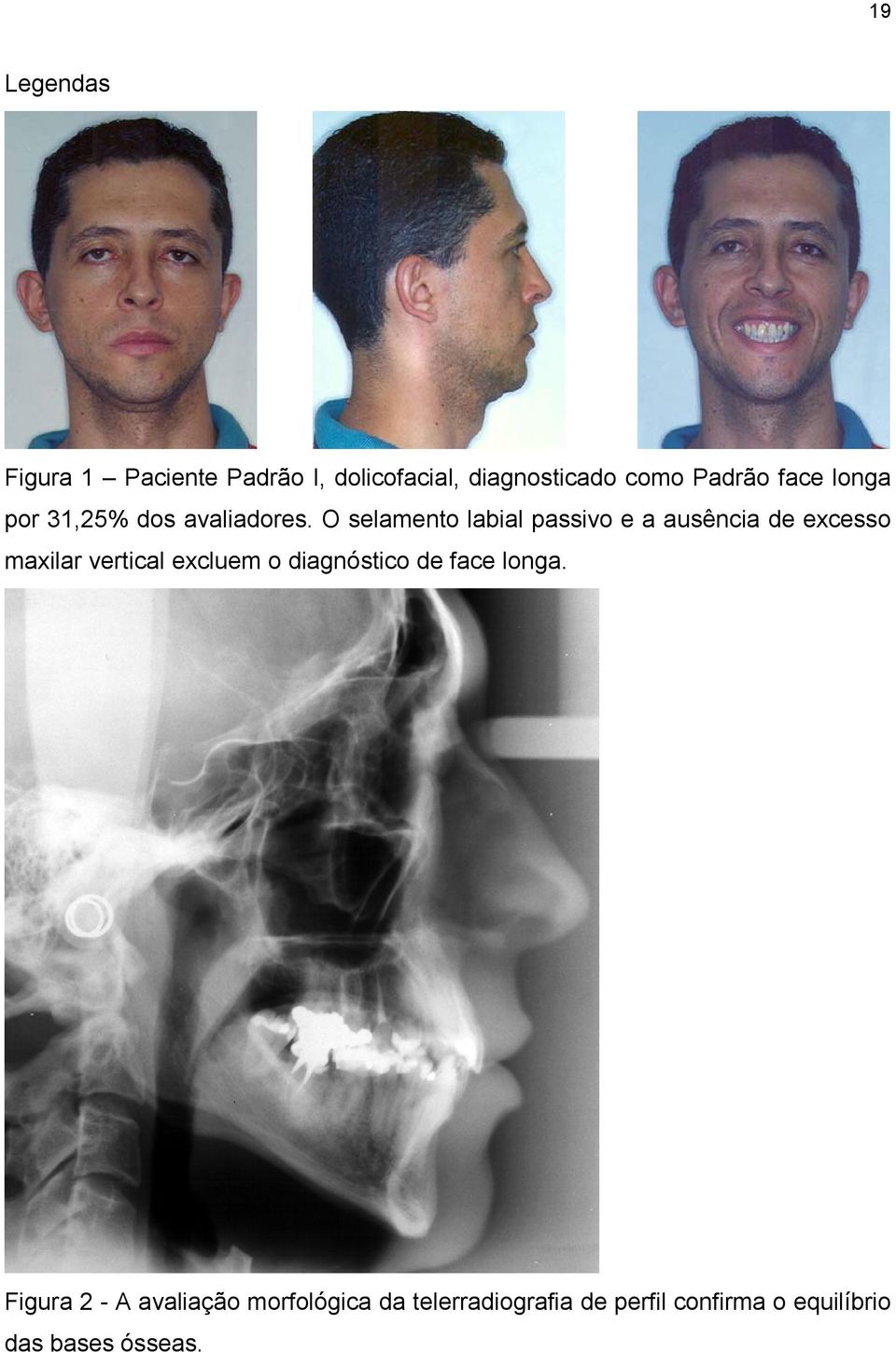 O selamento labial passivo e a ausência de excesso maxilar vertical excluem o