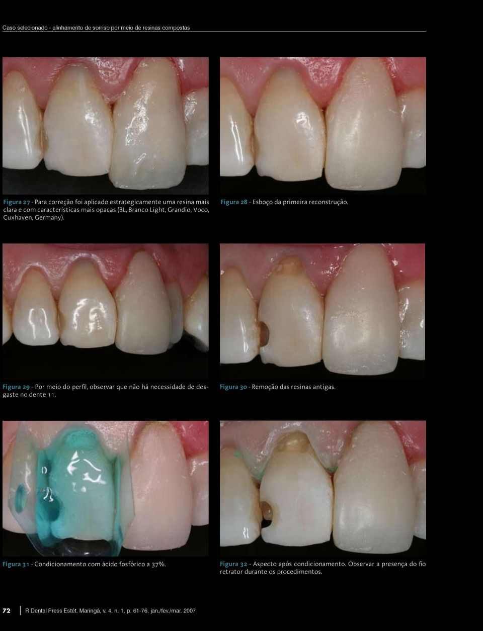 Figura 29 - Por meio do perfil, observar que não há necessidade de desgaste no dente 11. Figura 30 - Remoção das resinas antigas.