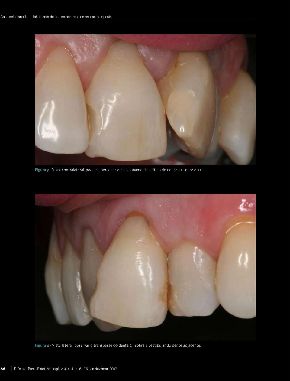 Figura 4 - Vista lateral, observar o transpasse do dente 21 sobre a vestibular do