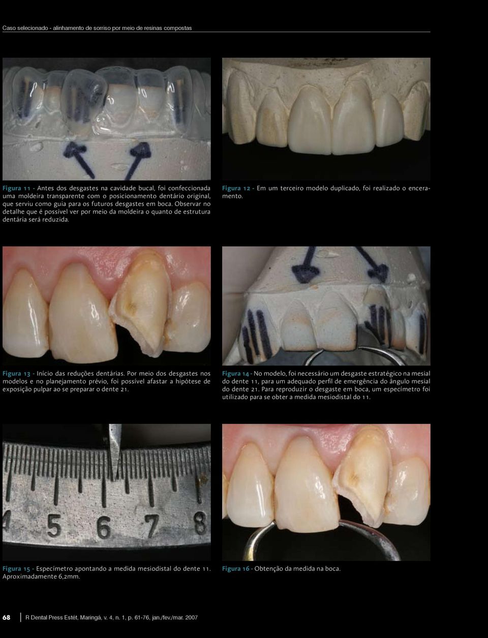 Figura 12 - Em um terceiro modelo duplicado, foi realizado o enceramento. Figura 13 - Início das reduções dentárias.