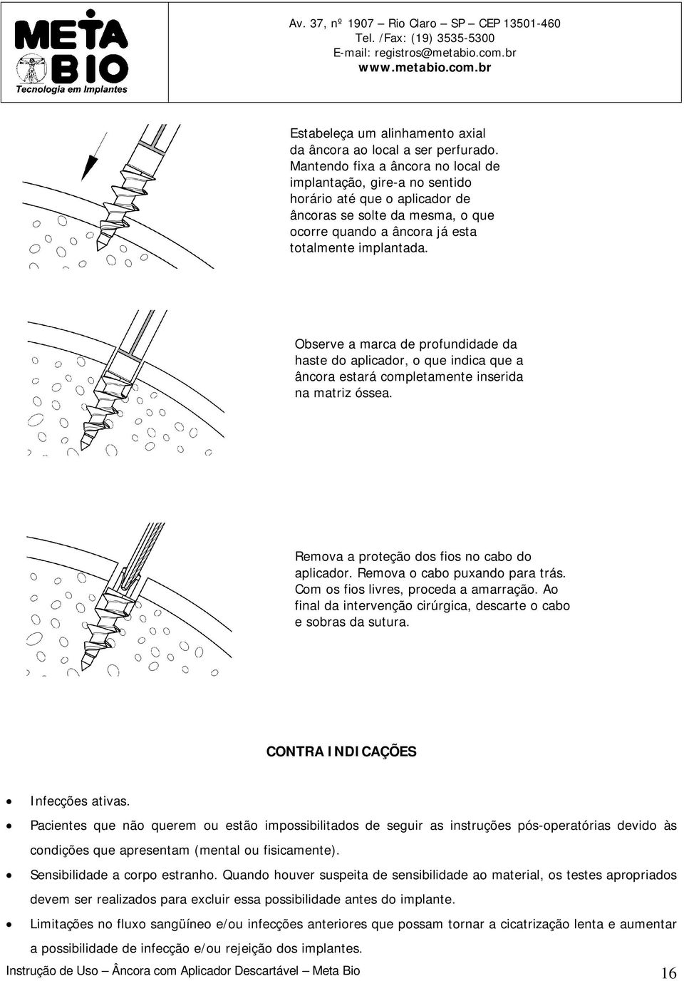 Observe a marca de profundidade da haste do aplicador, o que indica que a âncora estará completamente inserida na matriz óssea. Remova a proteção dos fios no cabo do aplicador.