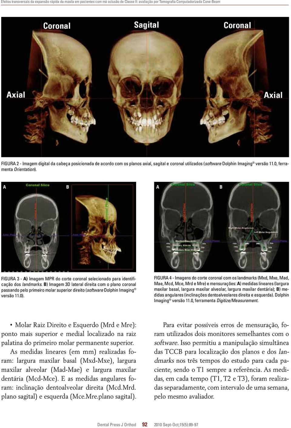 A B A B lmr FIGURA 3 - A) Imagem MPR do corte coronal selecionado para identificação dos landmarks.