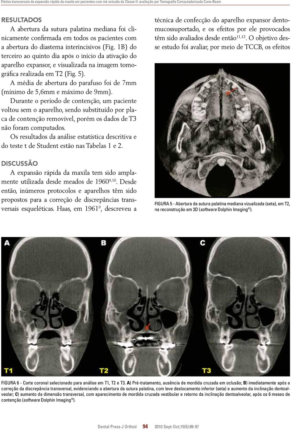 1B) do terceiro ao quinto dia após o início da ativação do aparelho expansor, e visualizada na imagem tomográfica realizada em T2 (Fig. 5).