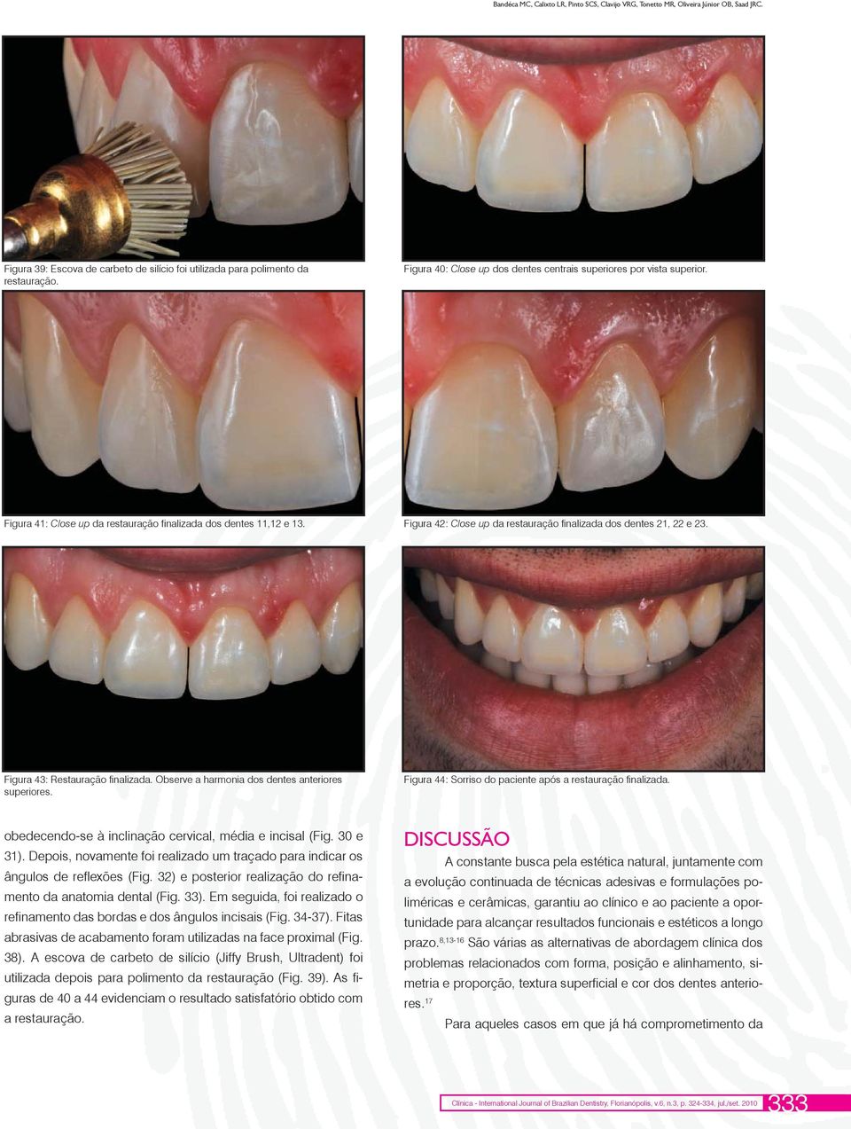 Figura 42: Close up da restauração finalizada dos dentes 21, 22 e 23. Figura 43: Restauração finalizada. Observe a harmonia dos dentes anteriores superiores.