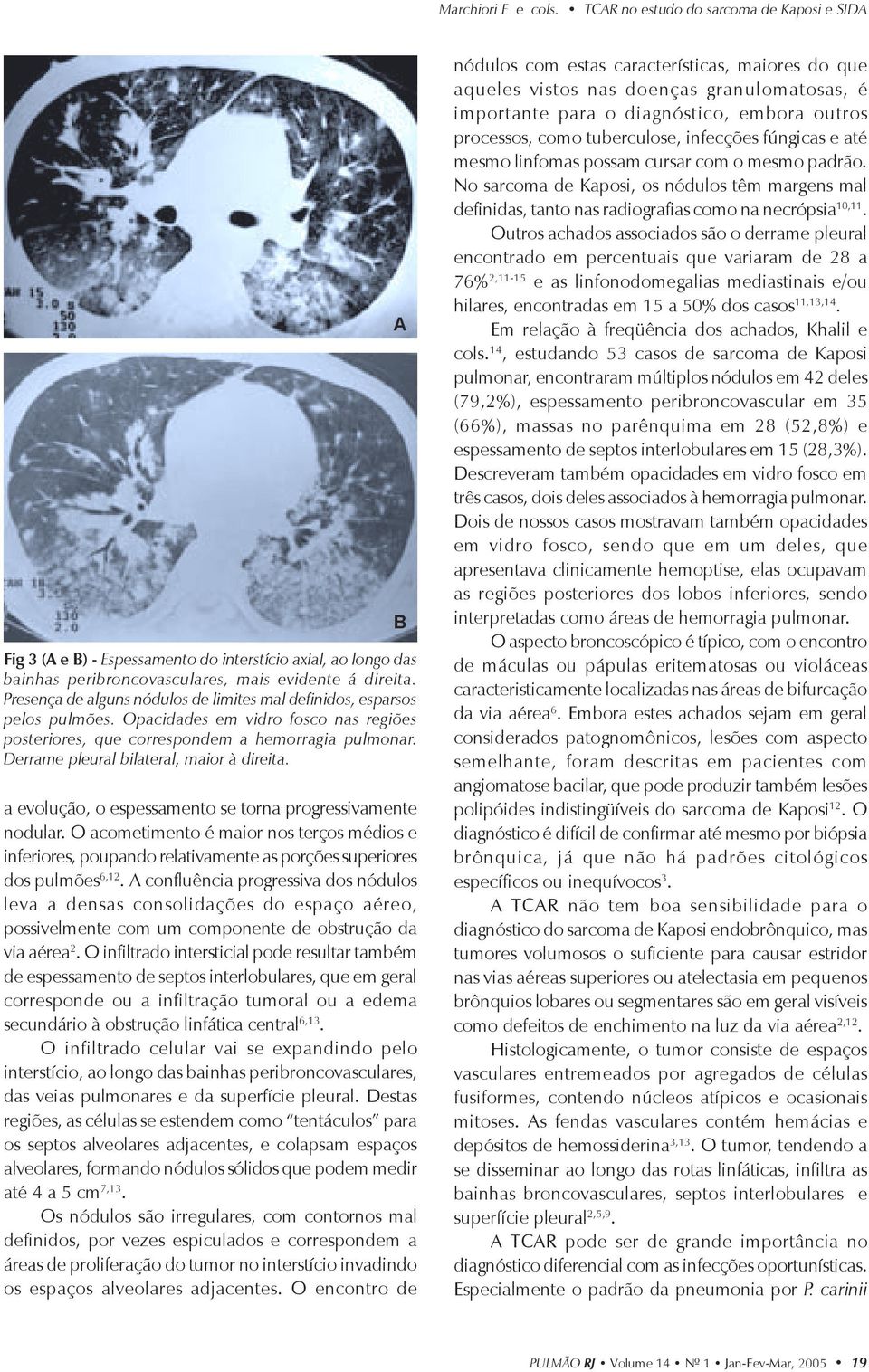 Derrame pleural bilateral, maior à direita. a evolução, o espessamento se torna progressivamente nodular.