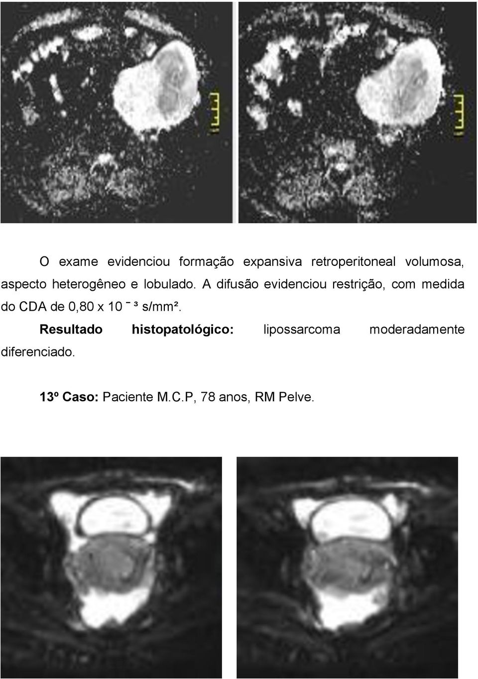 A difusão evidenciou restrição, com medida do CDA de 0,80 x 10 ˉ ³