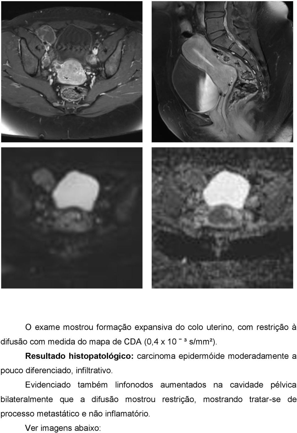 Resultado histopatológico: carcinoma epidermóide moderadamente a pouco diferenciado, infiltrativo.