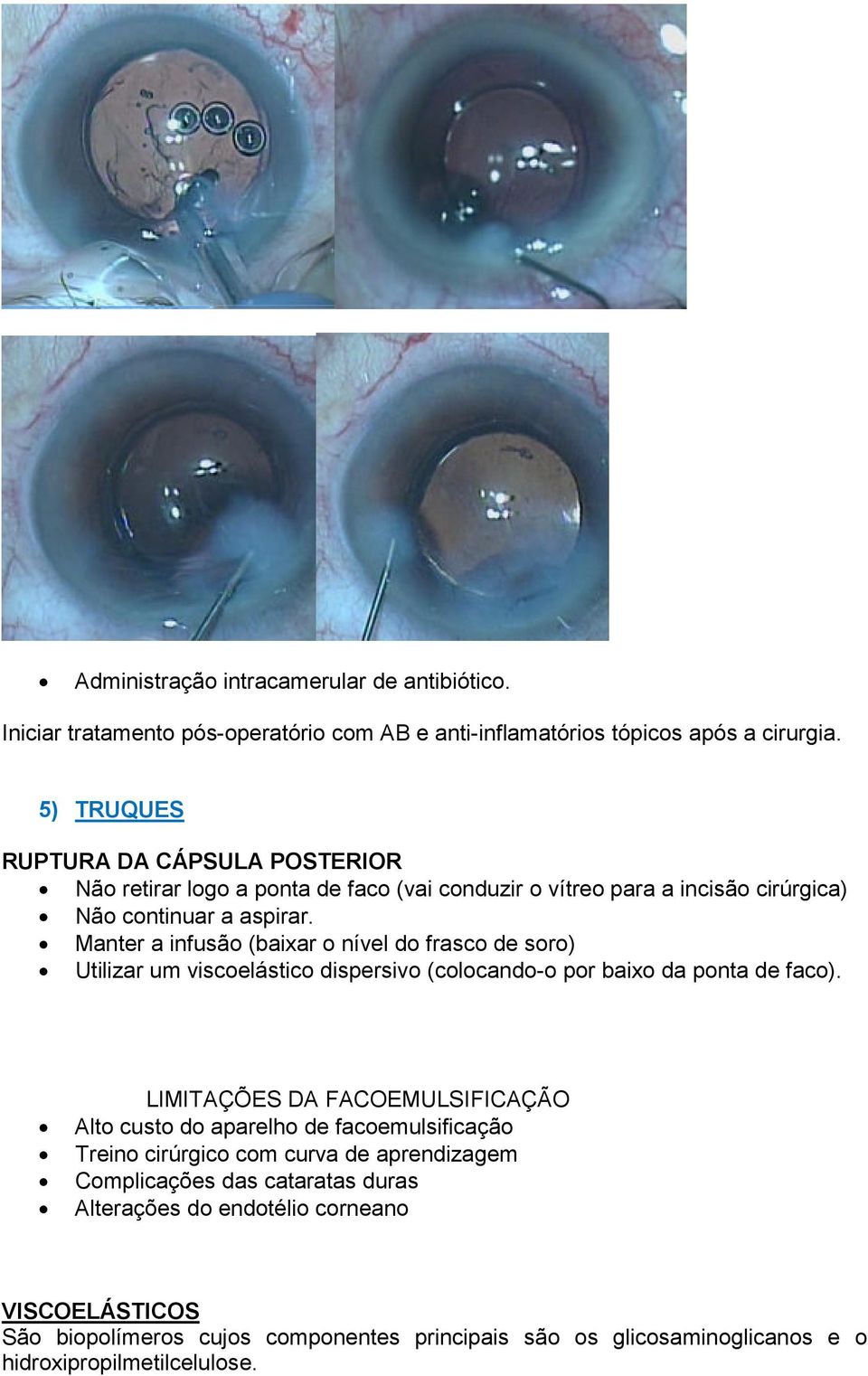 Manter a infusão (baixar o nível do frasco de soro) Utilizar um viscoelástico dispersivo (colocando-o por baixo da ponta de faco).