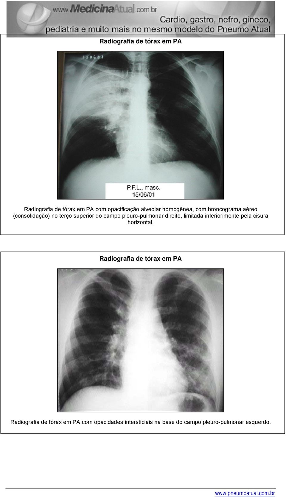 pleuro-pulmonar direito, limitada inferiorimente pela cisura horizontal.