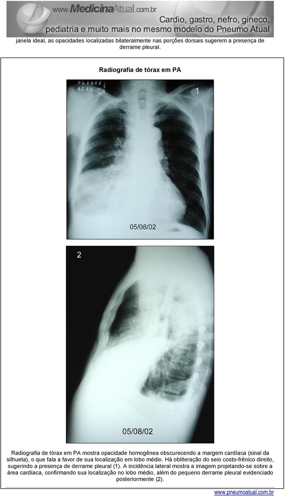 fala a favor de sua localização em lobo médio. Há obliteração do seio costo-frênico direito, sugerindo a presença de derrame pleural (1).