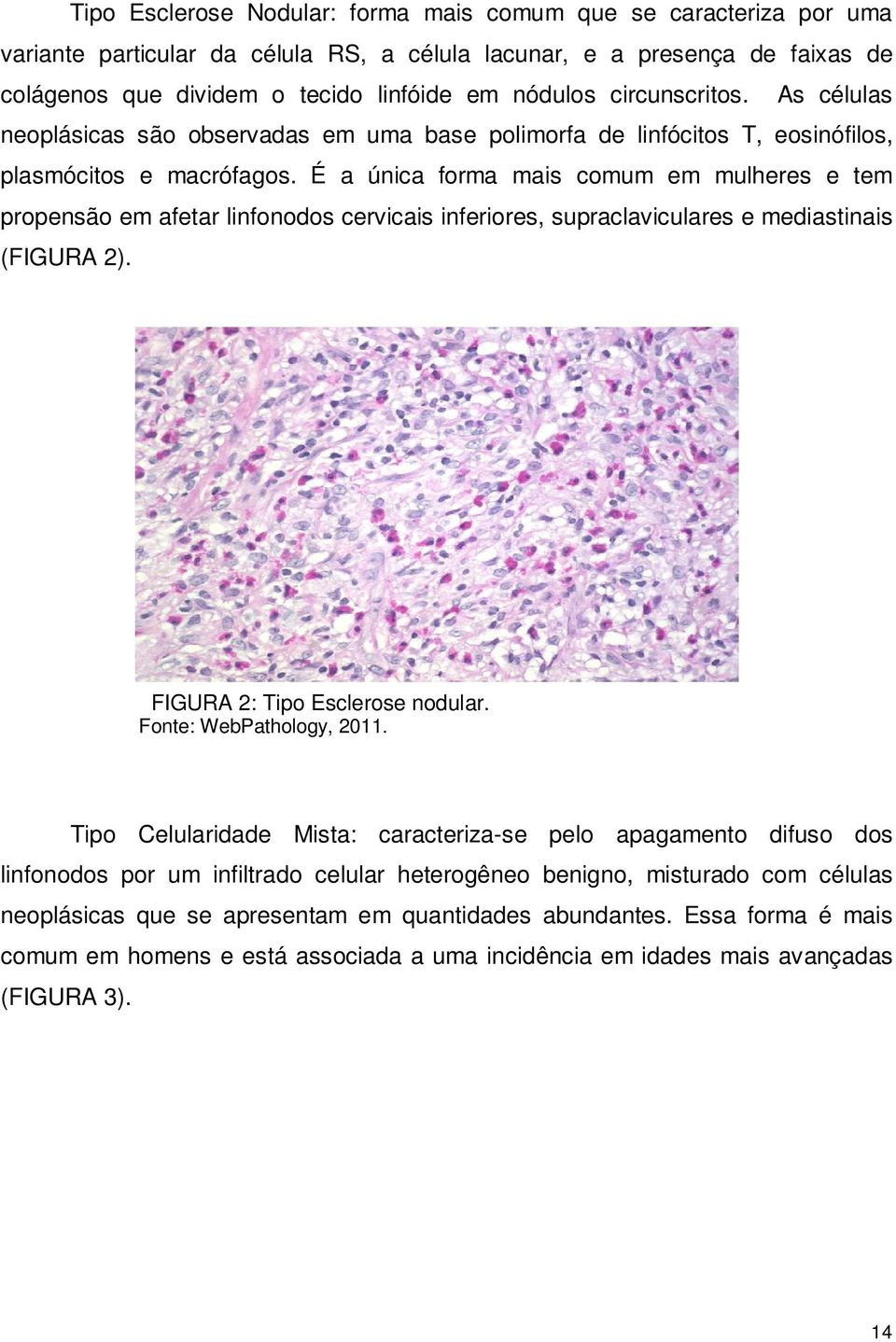 É a única forma mais comum em mulheres e tem propensão em afetar linfonodos cervicais inferiores, supraclaviculares e mediastinais (FIGURA 2). FIGURA 2: Tipo Esclerose nodular.