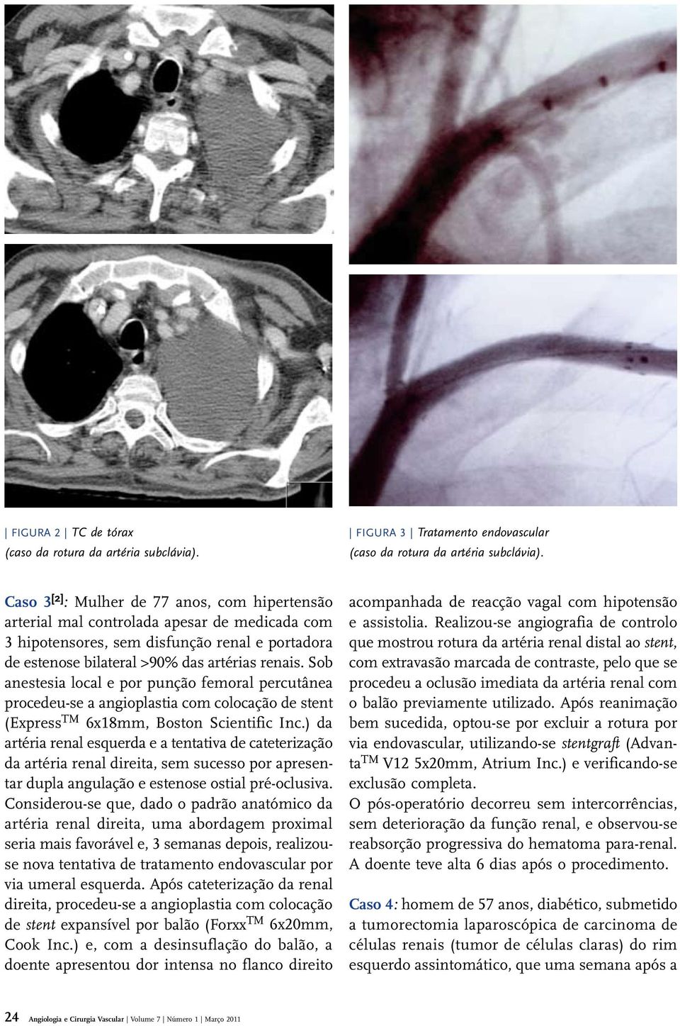 Sob anestesia local e por punção femoral percutânea procedeu-se a angioplastia com colocação de stent (Express TM 6x18mm, Boston Scientific Inc.