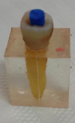 22 A odontometria foi realizada visualmente, com a introdução de uma lima tipo K #15 no conduto, com o uso de um limitador de borracha (stop), até que a ponta foi visualizada na saída do forame