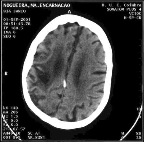 Variantes de Demência Vascular: Multienfartes corticais; multienfartes