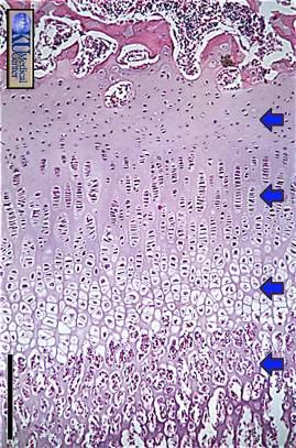 hipertróficos e calcificação da matriz territorial 4) Zona de Cartilagem Calcificada matriz apresenta-se