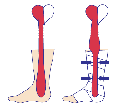 Terapia Compressiva Investigações médicas mostraram que a compressão elimina mais água do qu proteína do tecido, aumentando a pressão oncótica intersticial (do tecido).