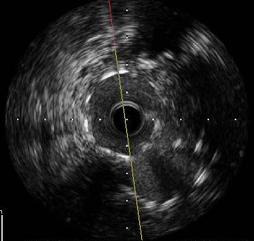 Angioplastia de Tronco há 3 meses em outra Instituição Sem Utilizar IVUS JS - 76