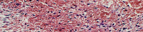 Terço médio junto ao centro do alvéolo com coágulo sangüíneo e discreto número de fibroblastos e raros linfócitos.