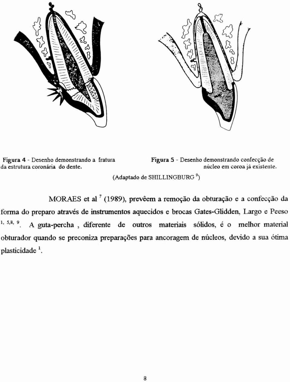 (Adaptado de SHILLINGBURG 9) MORAES et al 7 (1989), prevêem a remoção da obturação e a confecção da forma do preparo através de