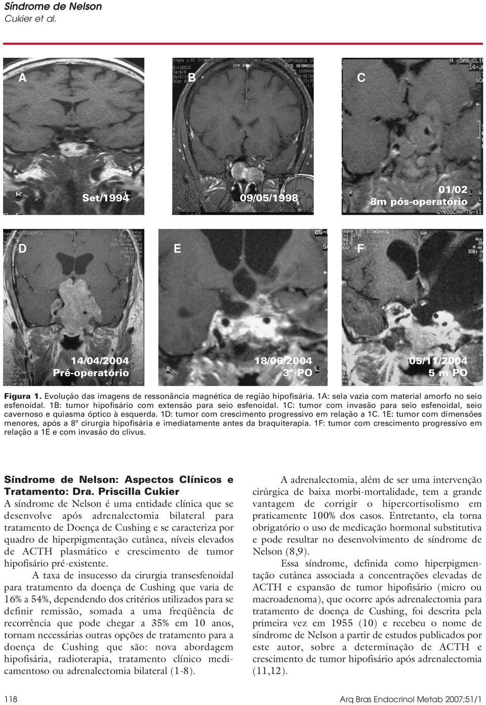 1C: tumor com invasão para seio esfenoidal, seio cavernoso e quiasma óptico à esquerda. 1D: tumor com crescimento progressivo em relação a 1C.