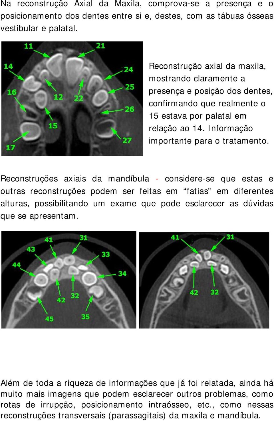 Reconstruções axiais da mandíbula - considere-se que estas e outras reconstruções podem ser feitas em fatias em diferentes alturas, possibilitando um exame que pode esclarecer as dúvidas que se