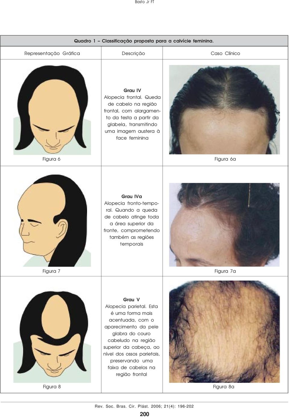 Grau IVa Alopecia fronto-temporal.