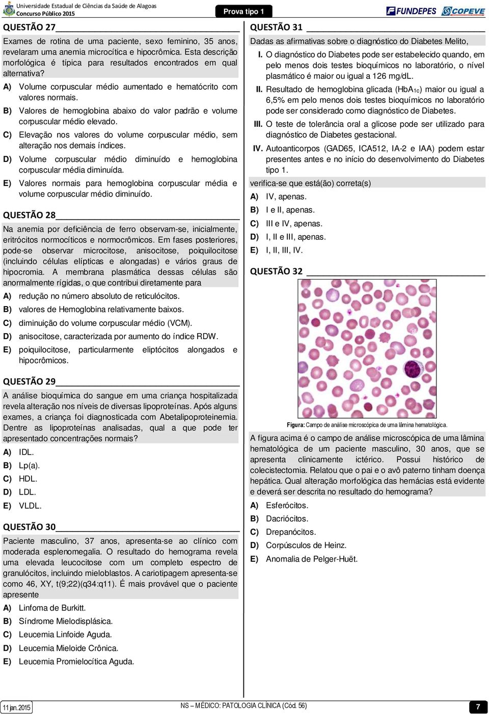 B) Valores de hemoglobina abaixo do valor padrão e volume corpuscular médio elevado. C) Elevação nos valores do volume corpuscular médio, sem alteração nos demais índices.