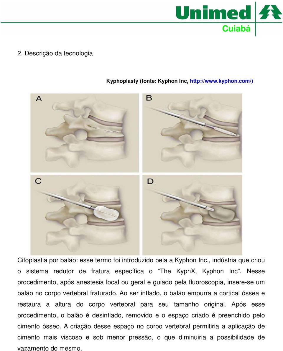 Nesse procedimento, após anestesia local ou geral e guiado pela fluoroscopia, insere-se um balão no corpo vertebral fraturado.