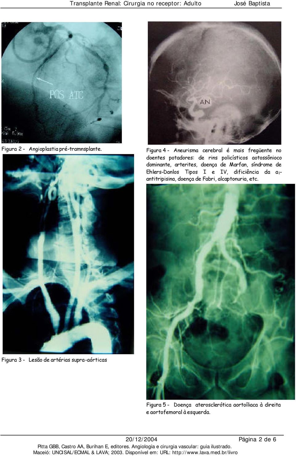 dominante, arterites, doença de Marfan, síndrome de Ehlers-Danlos Tipos I e IV, dificiência da a 1-