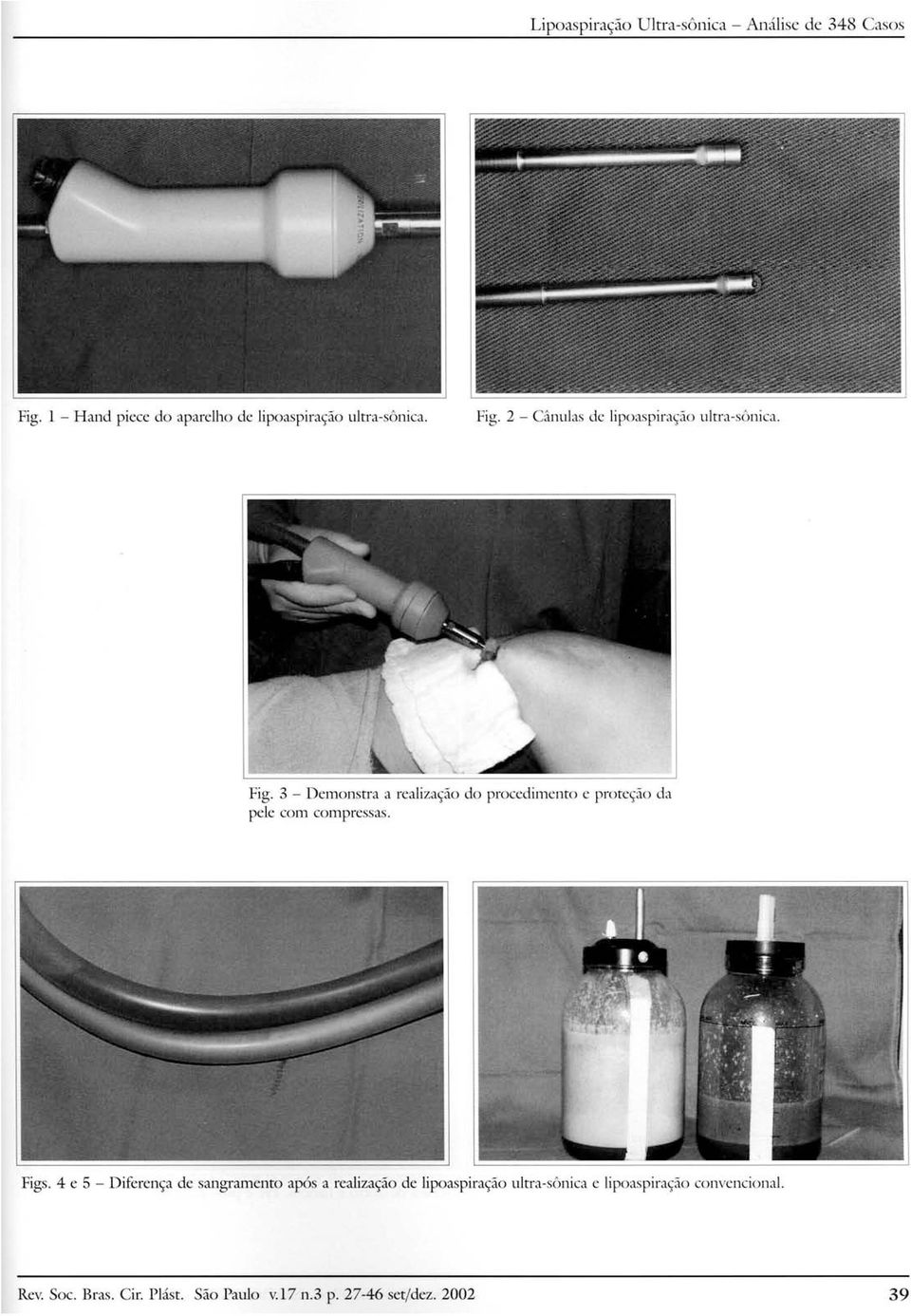Fig. 3 - Demonstra a realização do procedimento e proteção da pele com compressas. Figs.